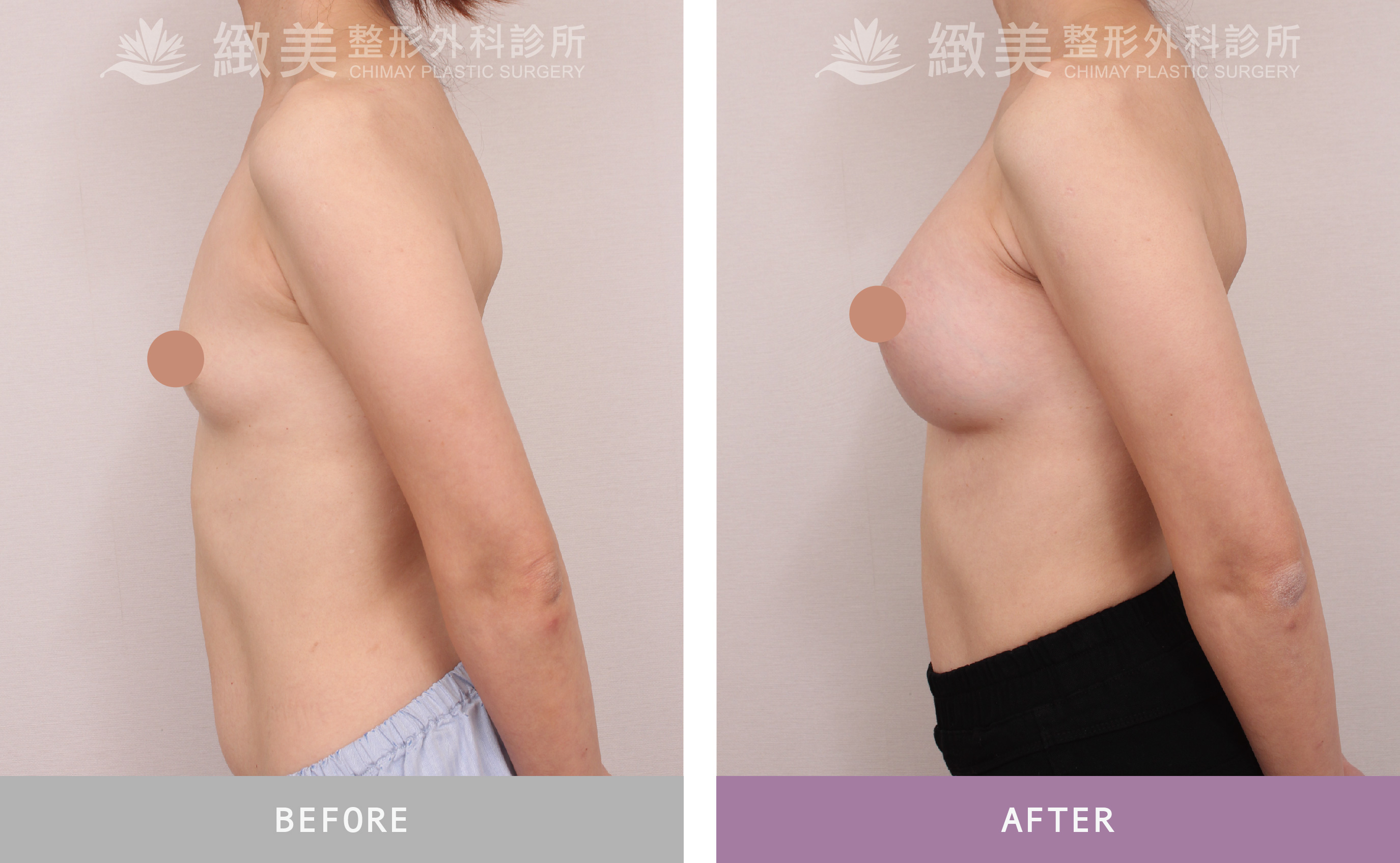 曼陀尊貴(Xtra女王波)隆乳 術後一個月