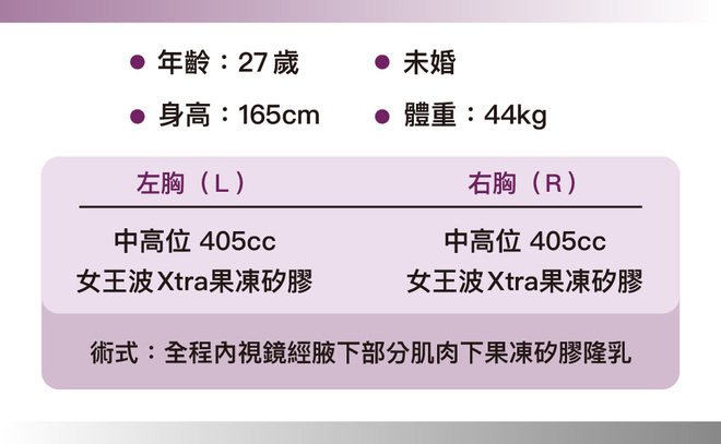 曼陀尊貴(Xtra女王波)隆乳 術後一個月