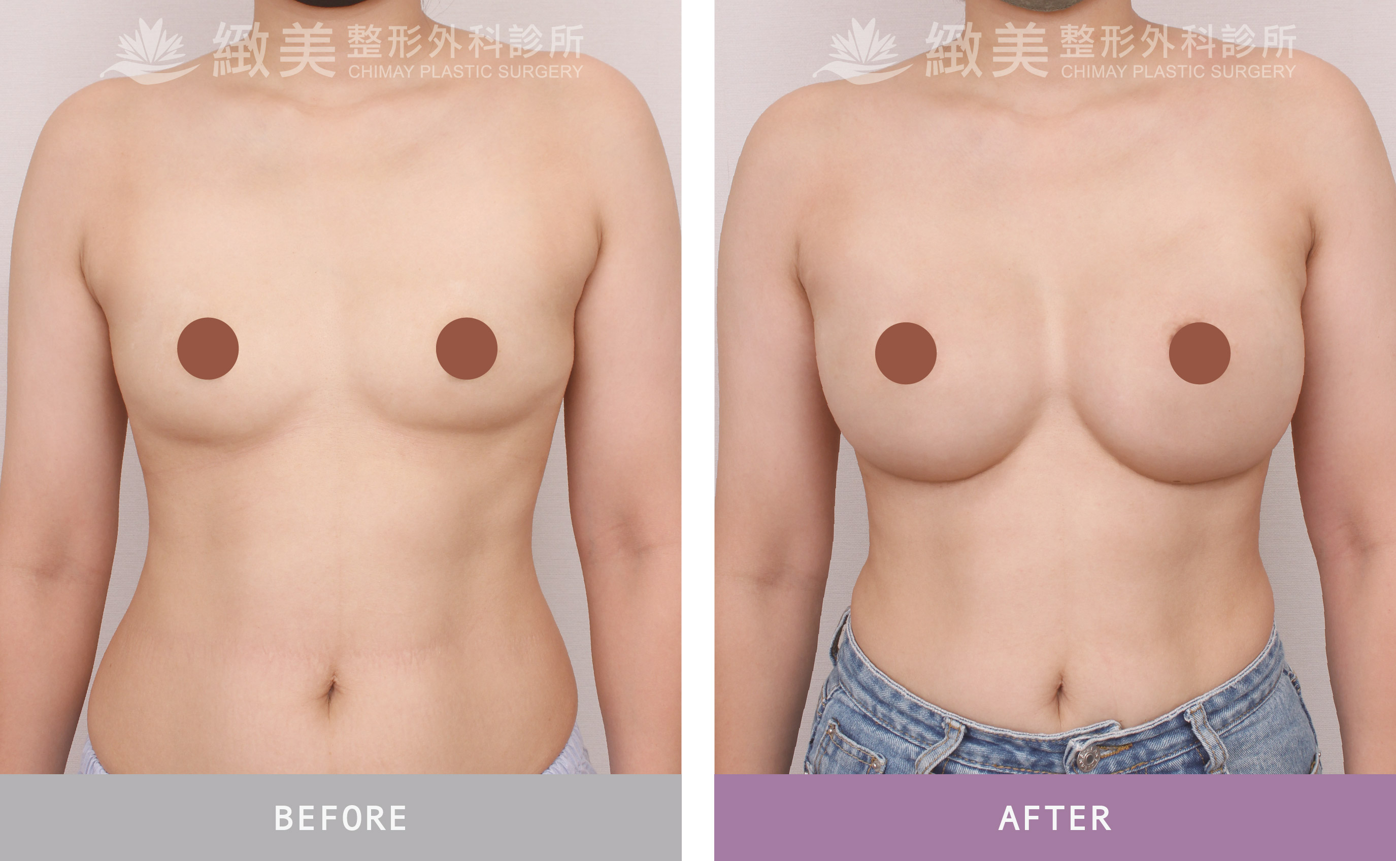 曼陀尊貴(Xtra女王波)隆乳 術後一個月