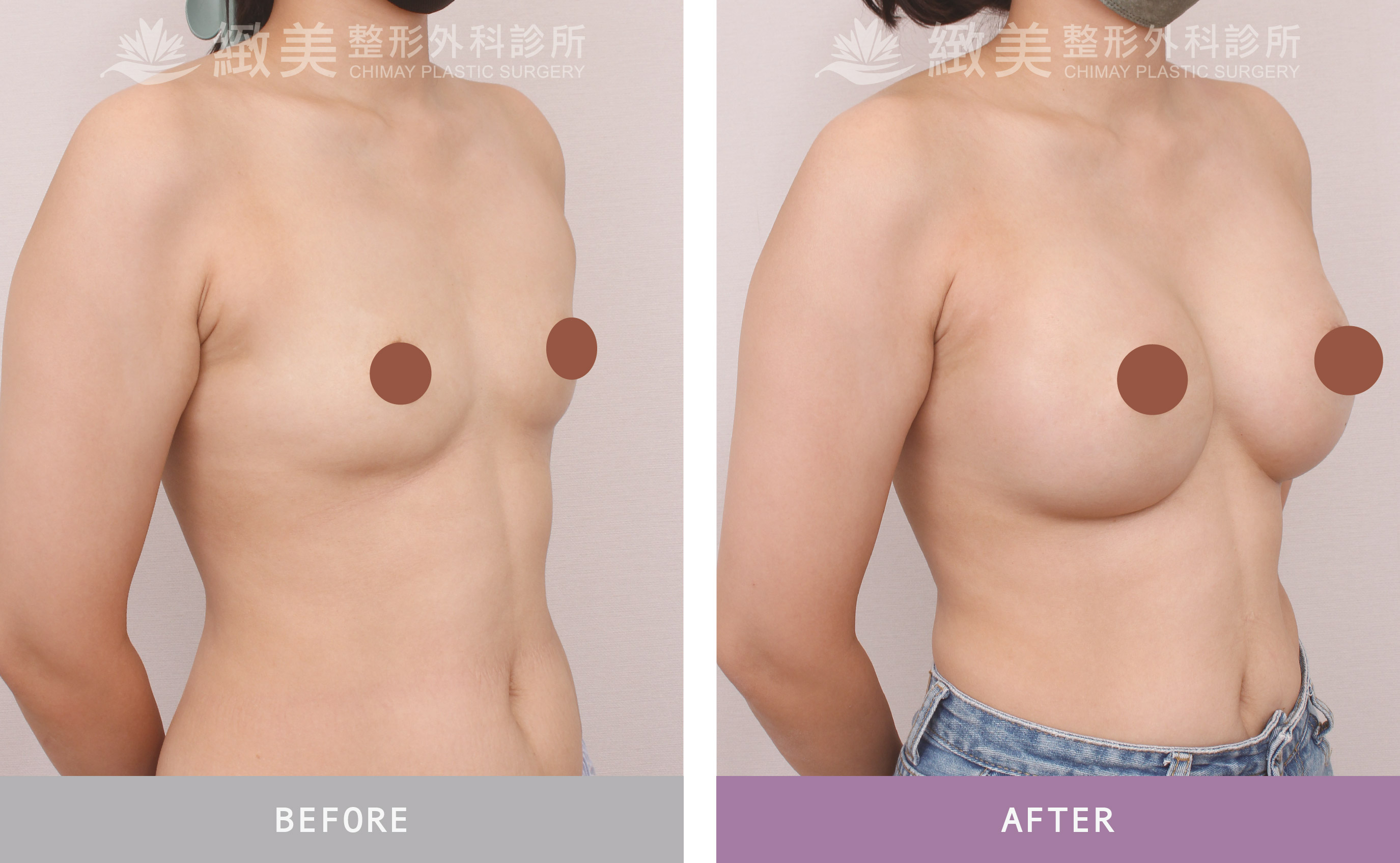 曼陀尊貴(Xtra女王波)隆乳 術後一個月