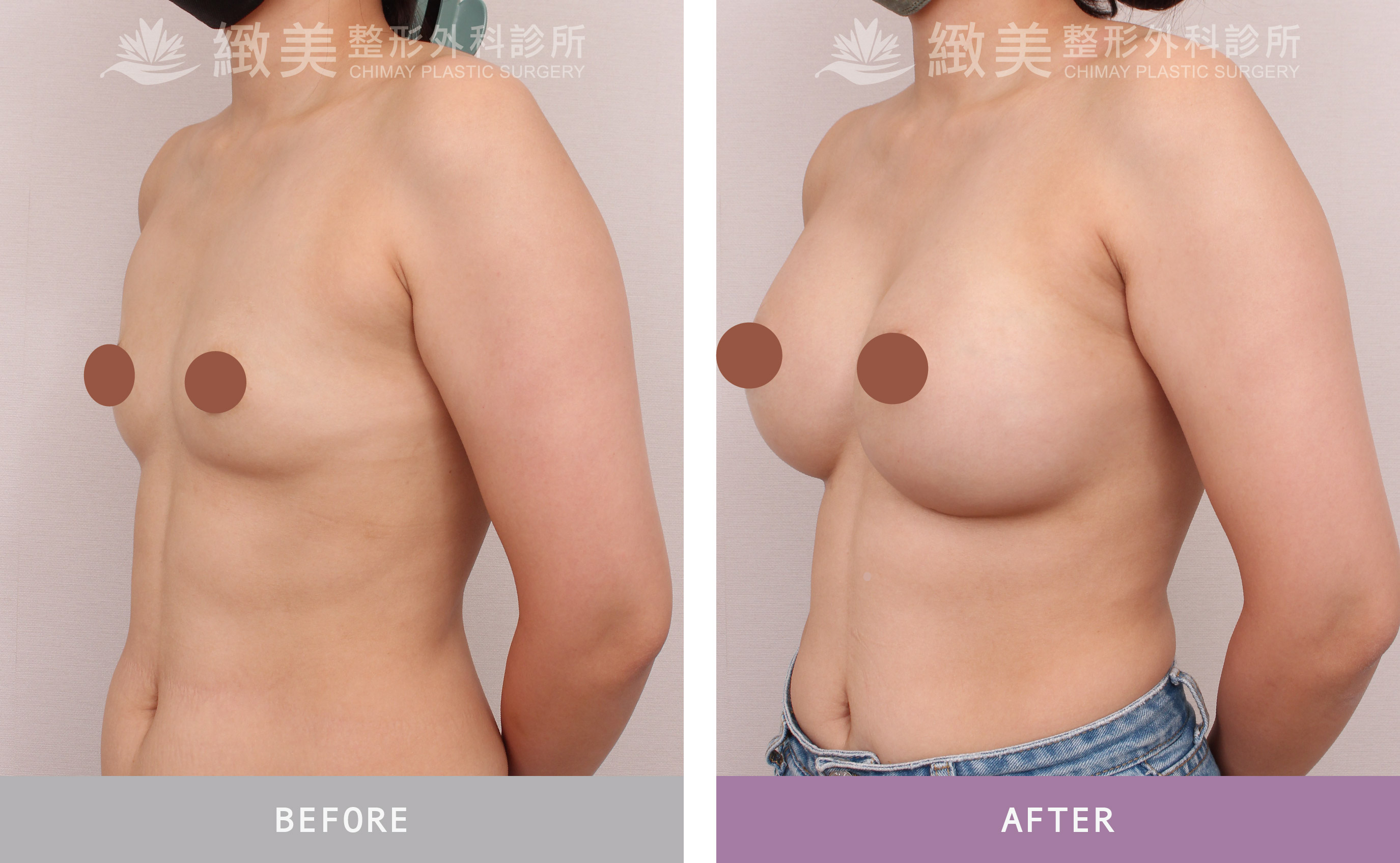 曼陀尊貴(Xtra女王波)隆乳 術後一個月