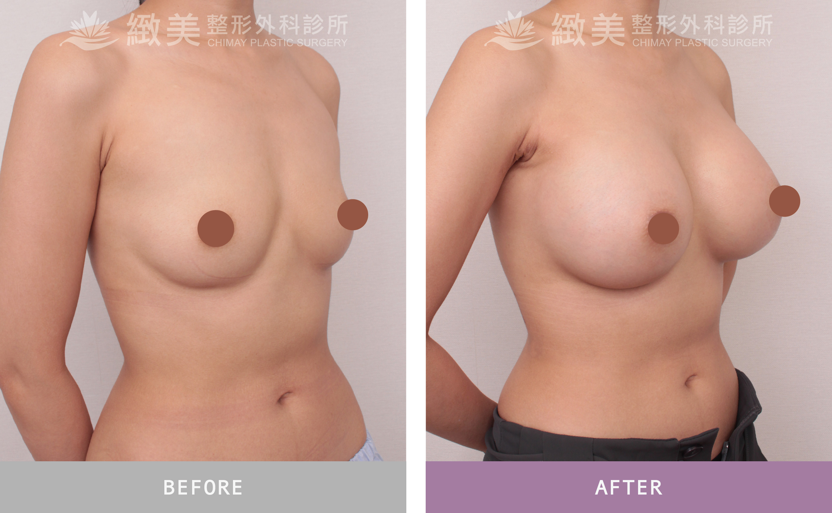 曼陀尊貴(Xtra女王波)隆乳 術後一個月