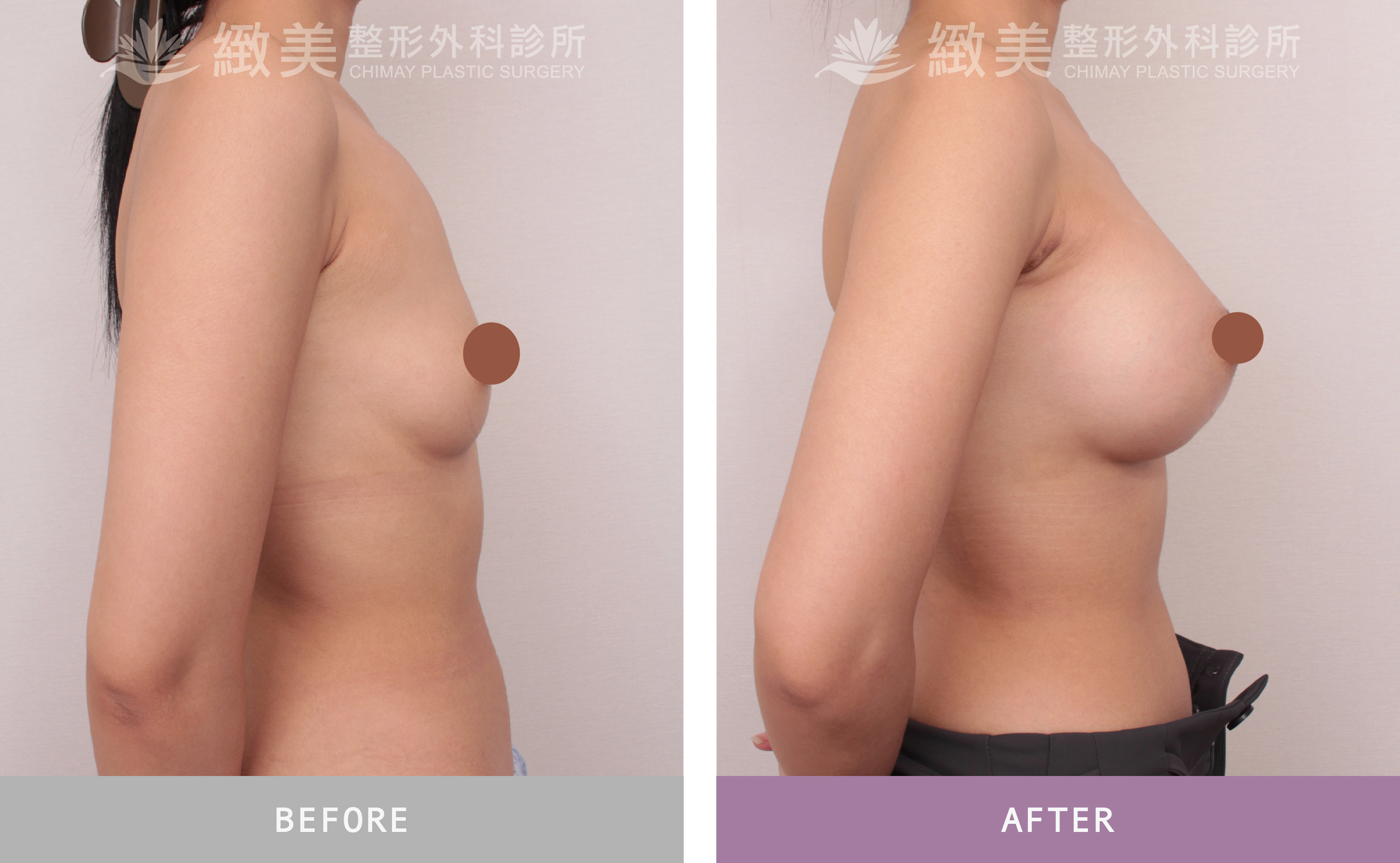 曼陀尊貴(Xtra女王波)隆乳 術後一個月