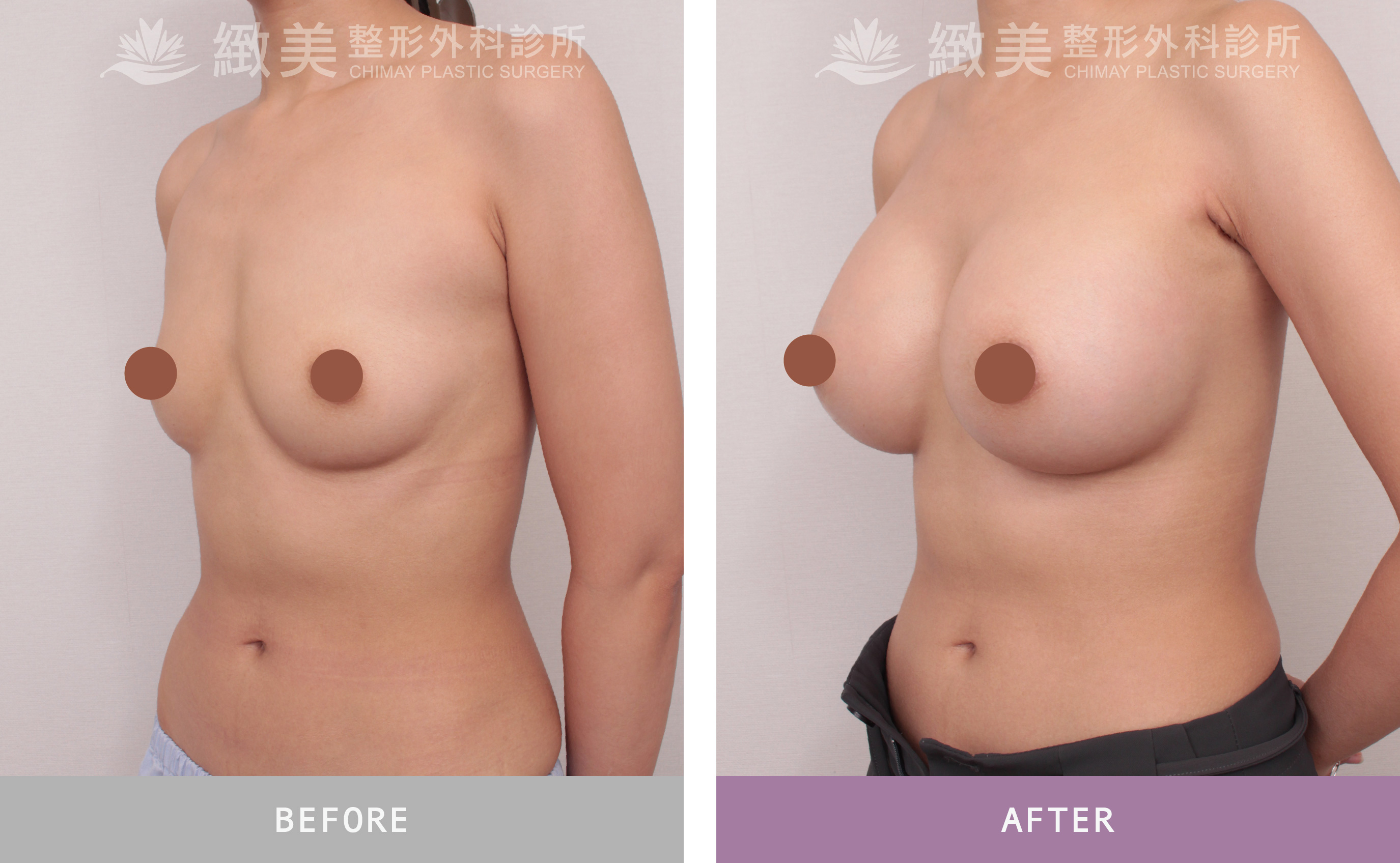 曼陀尊貴(Xtra女王波)隆乳 術後一個月