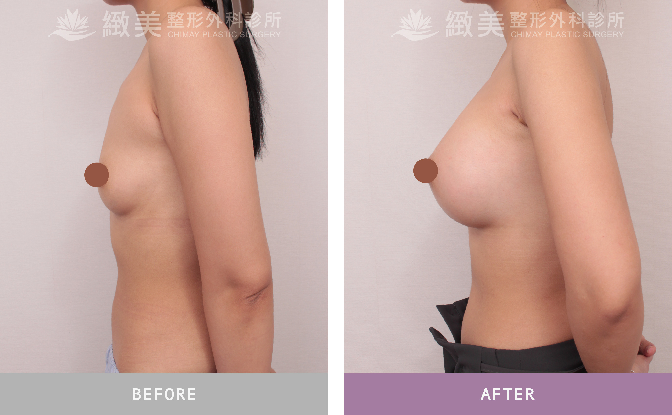 曼陀尊貴(Xtra女王波)隆乳 術後一個月