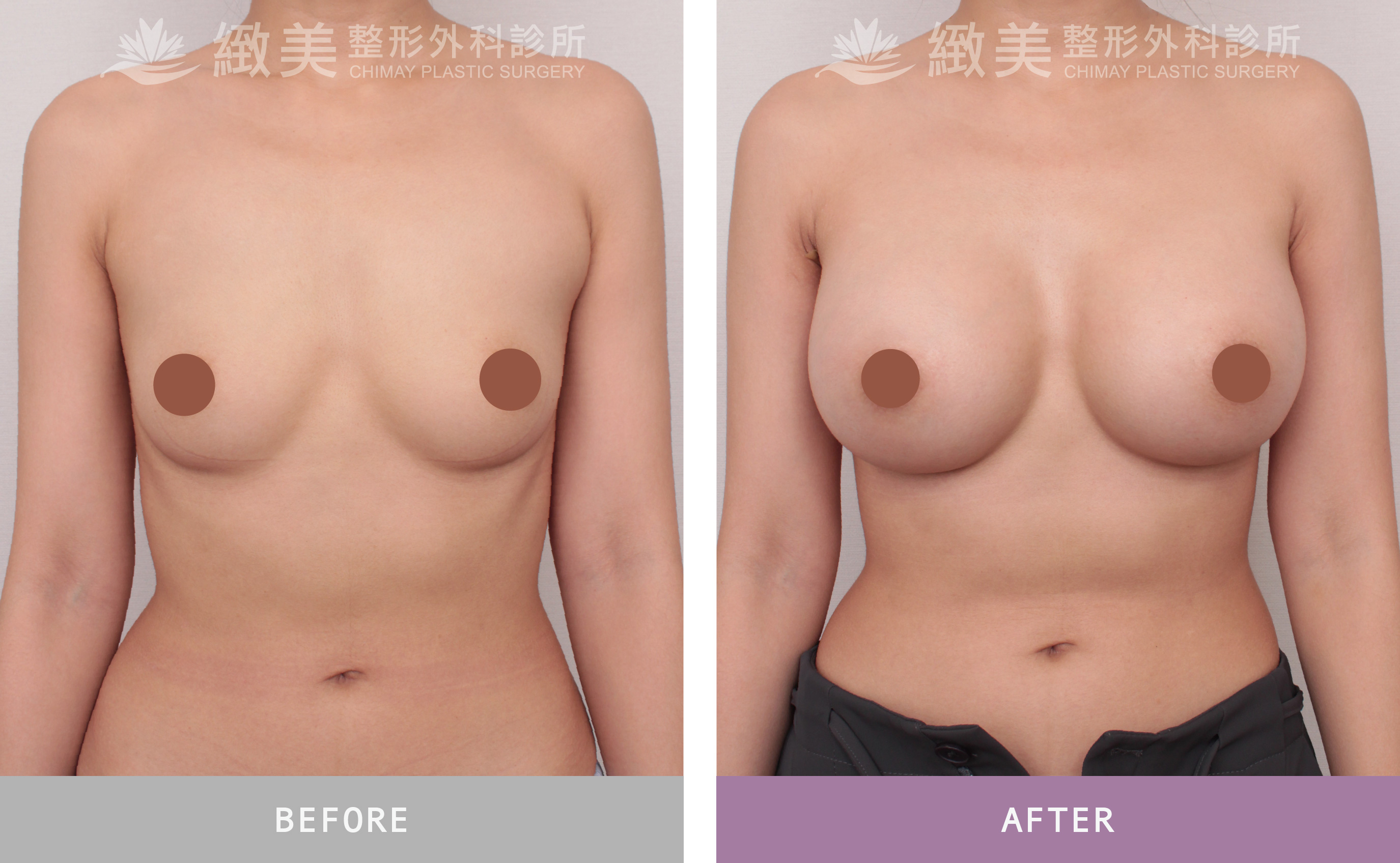 曼陀尊貴(Xtra女王波)隆乳 術後一個月