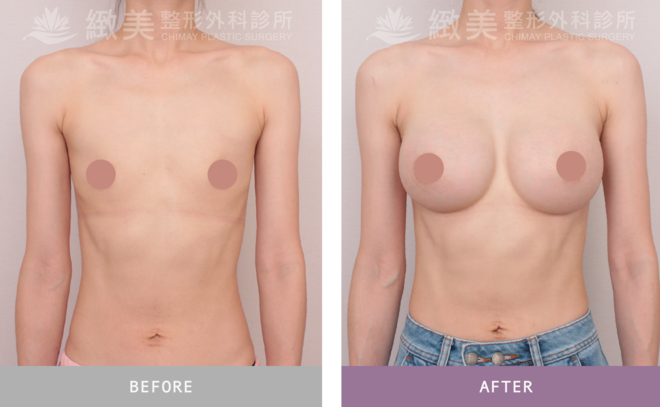 魔滴2.0隆乳 術後3個月