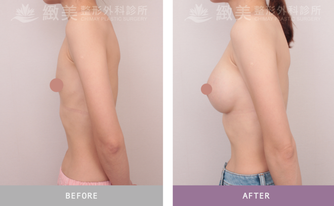 魔滴2.0隆乳 術後3個月