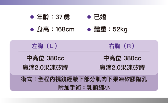 魔滴2.0隆乳 術後3個月