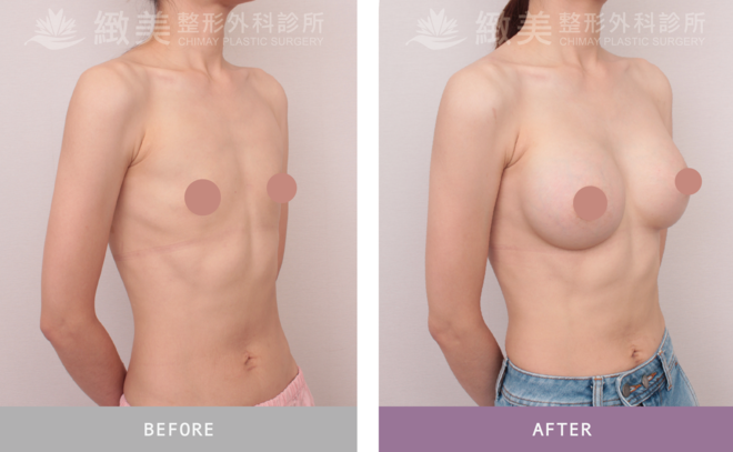 魔滴2.0隆乳 術後3個月