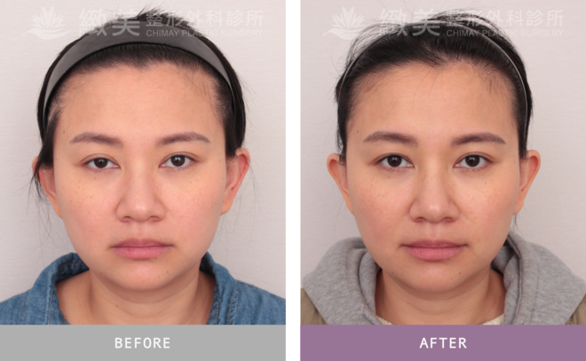 單(右)眼提眼瞼肌 術後2個月