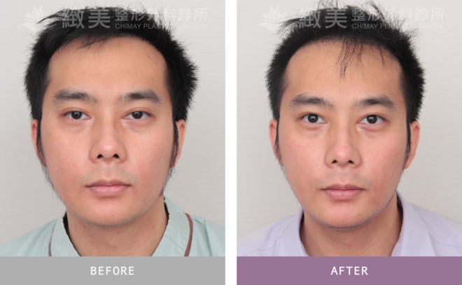 雙眼提眼瞼肌 術後1個月