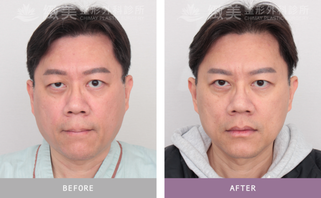 單(右)眼-提眼瞼肌＋縫雙眼皮 術後5個月