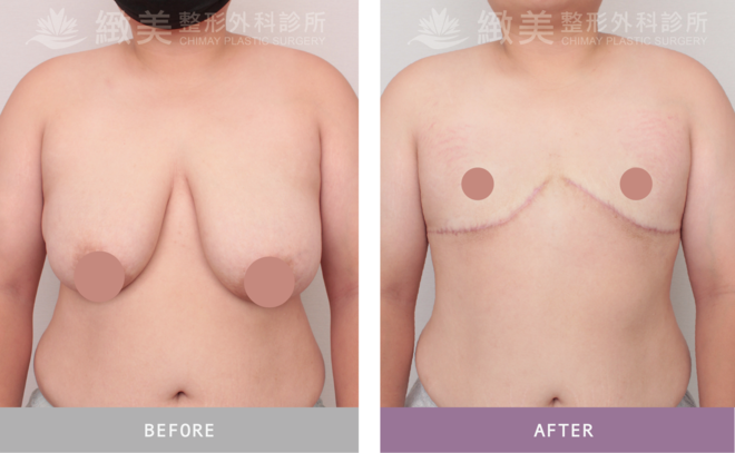 平胸全切術後6個月