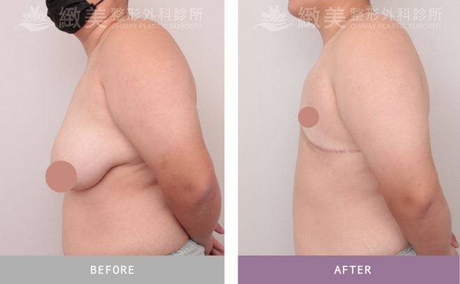 平胸全切術後6個月