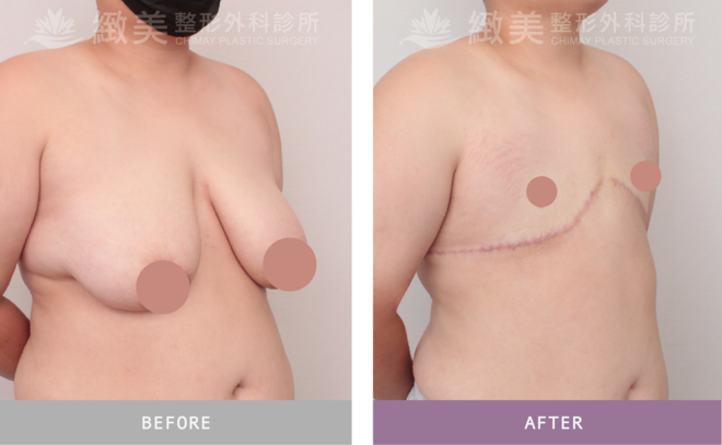 平胸全切術後6個月