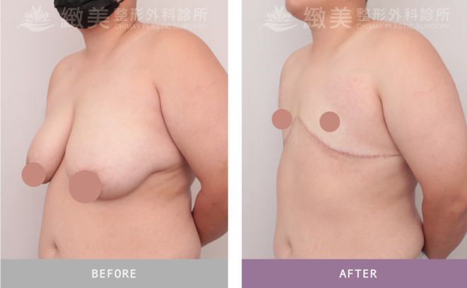 平胸全切術後6個月