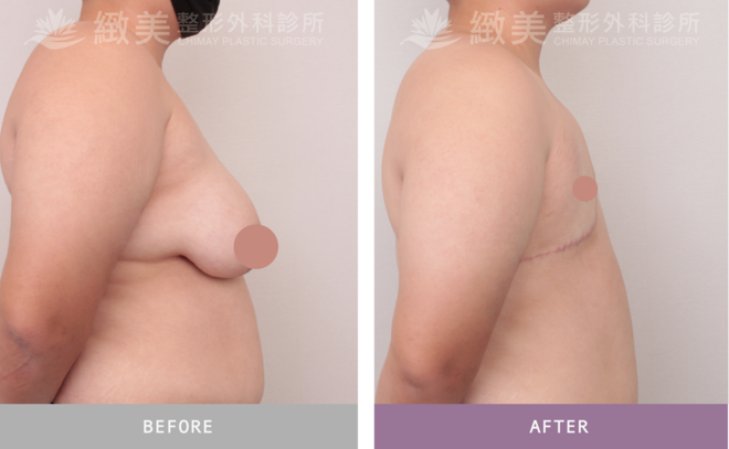 平胸全切術後6個月