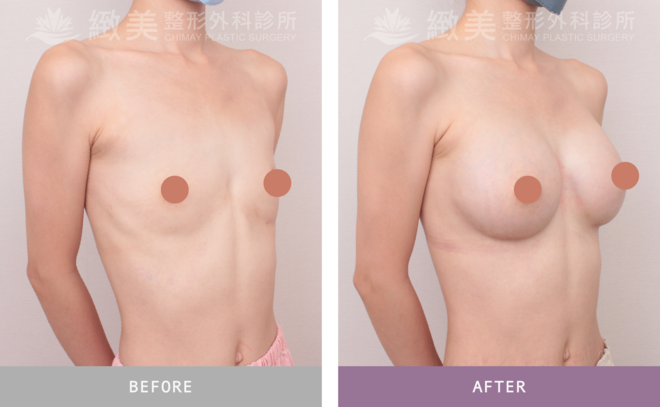 珍珠波隆乳 術後6個月 