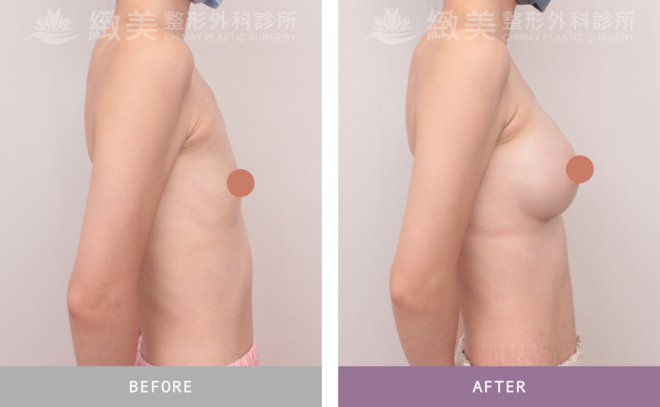 珍珠波隆乳 術後6個月 