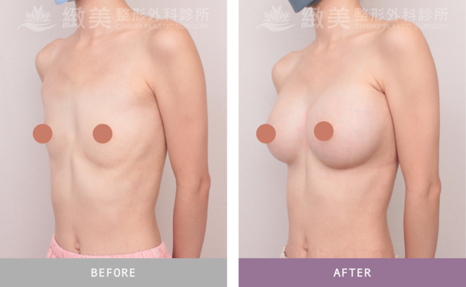 珍珠波隆乳 術後6個月 