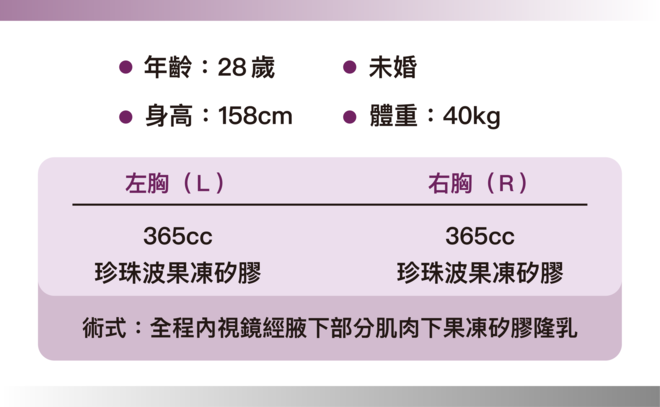 珍珠波隆乳 術後6個月