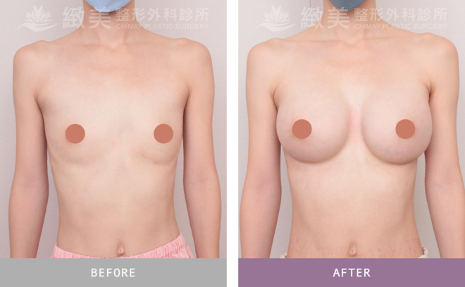 珍珠波隆乳 術後6個月