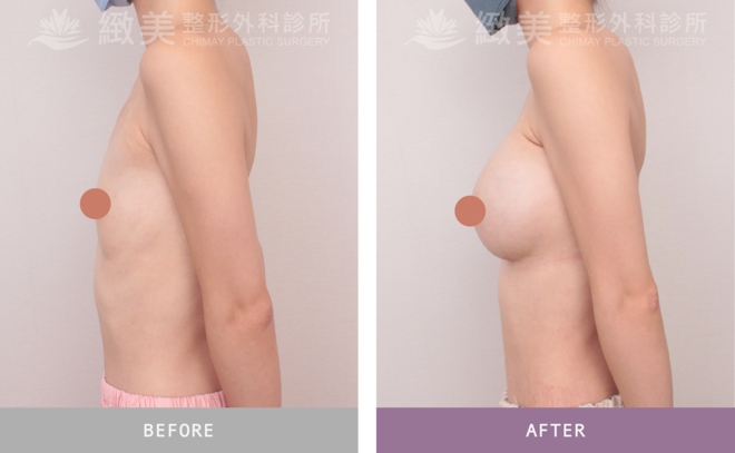 珍珠波隆乳 術後6個月