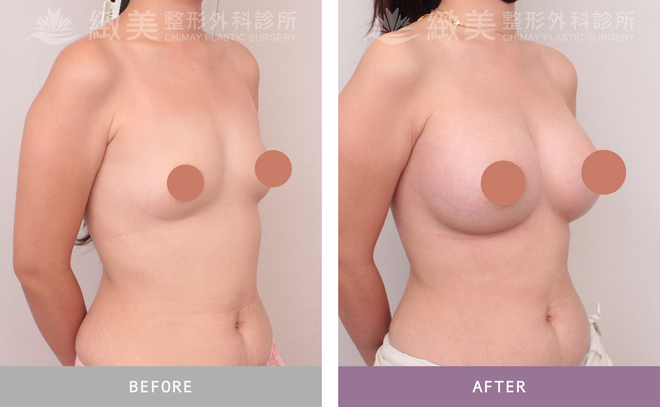 珍珠波隆乳 術後7個月 