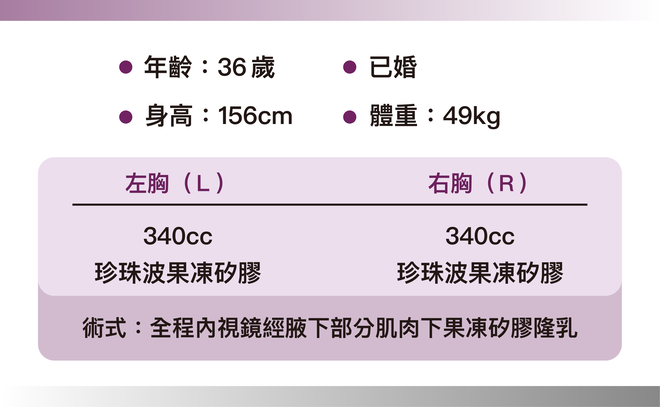 珍珠波隆乳 術後7個月 