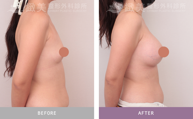 珍珠波隆乳 術後7個月 