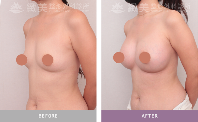 珍珠波隆乳 術後7個月 