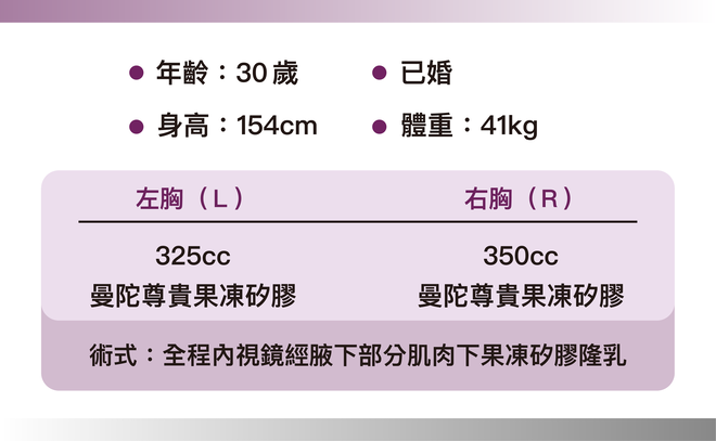曼陀尊貴(Xtra女王波)隆乳 術後三個月