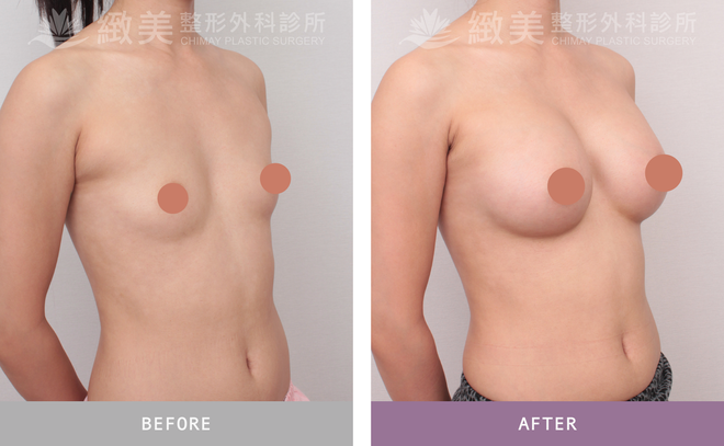 曼陀尊貴(Xtra女王波)隆乳 術後三個月