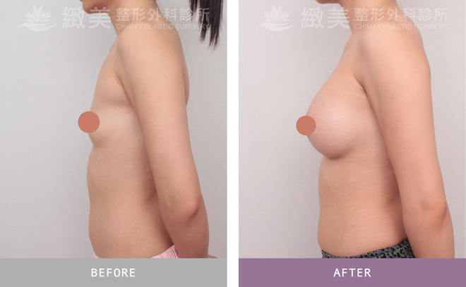 曼陀尊貴(Xtra女王波)隆乳 術後三個月