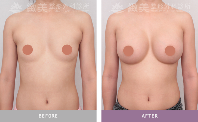 Xtra女王波隆乳 術後3個月
