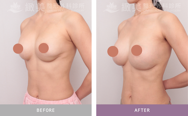 隆乳重做 術後3個月