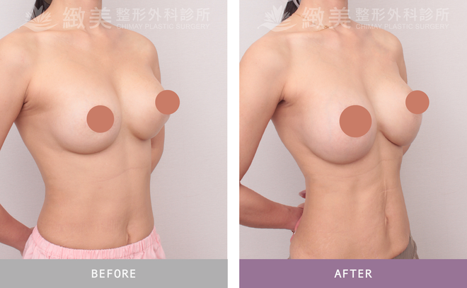 隆乳重做 術後3個月