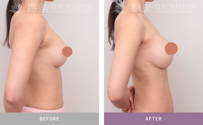 隆乳重做 術後3個月
