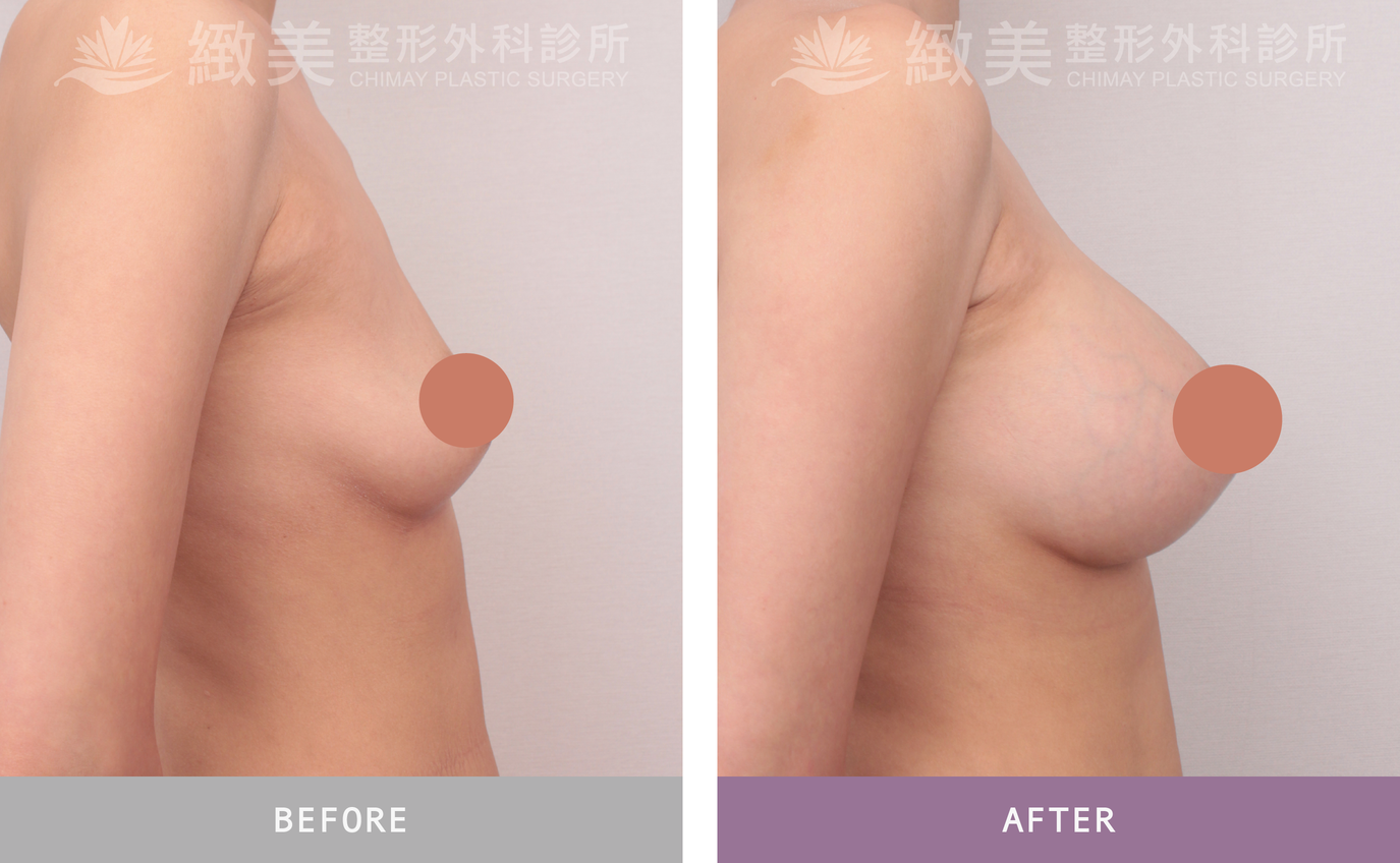 曼陀尊貴(Xtra女王波)隆乳 術後3個月