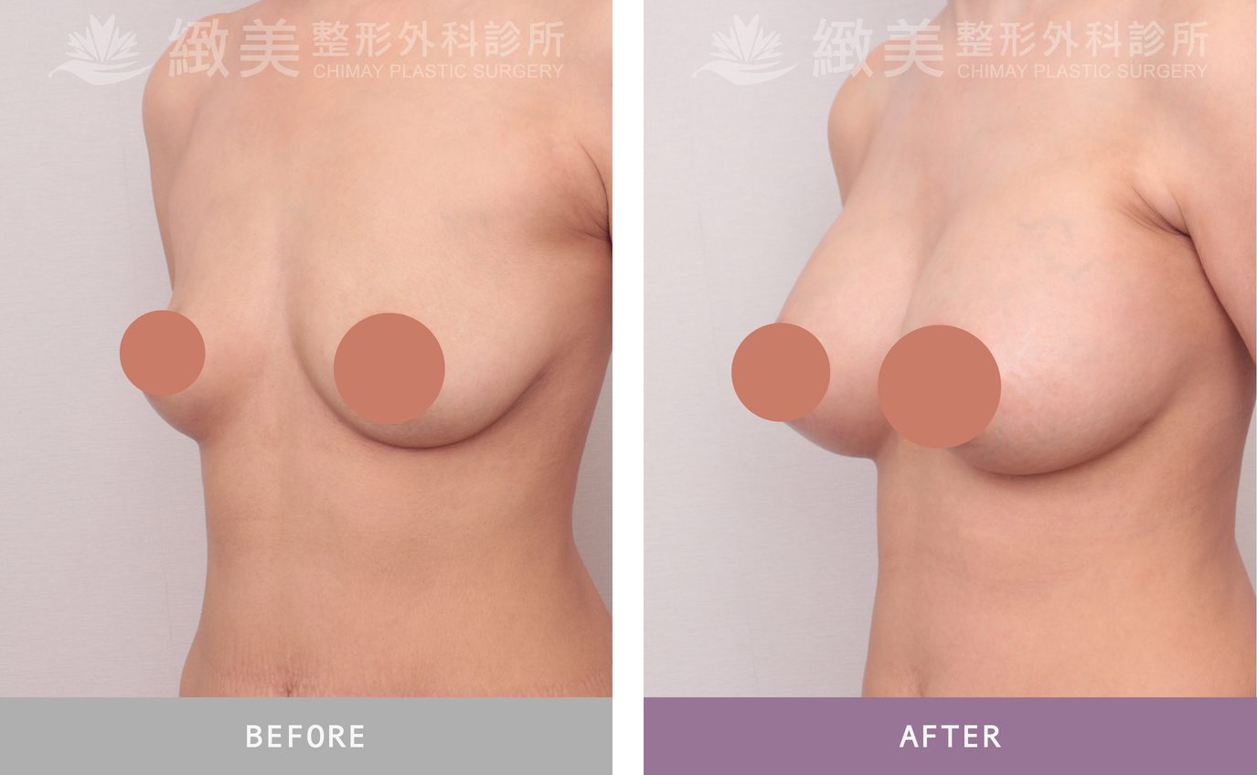 曼陀尊貴(Xtra女王波)隆乳 術後3個月