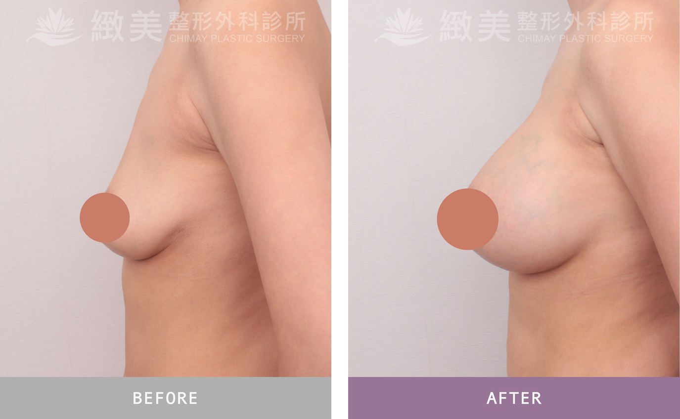 曼陀尊貴(Xtra女王波)隆乳 術後3個月