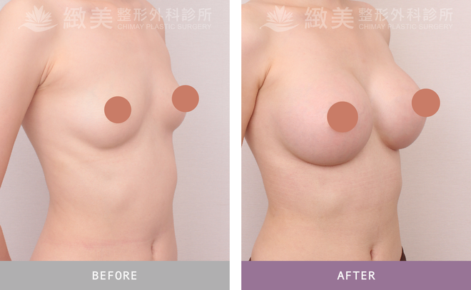 曼陀尊貴(Xtra女王波)隆乳 術後三個月