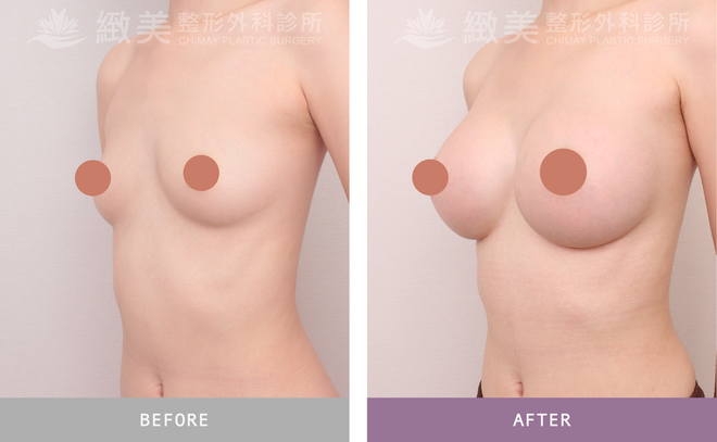 曼陀尊貴(Xtra女王波)隆乳 術後三個月
