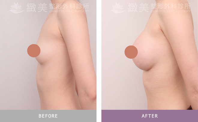 曼陀尊貴(Xtra女王波)隆乳 術後三個月