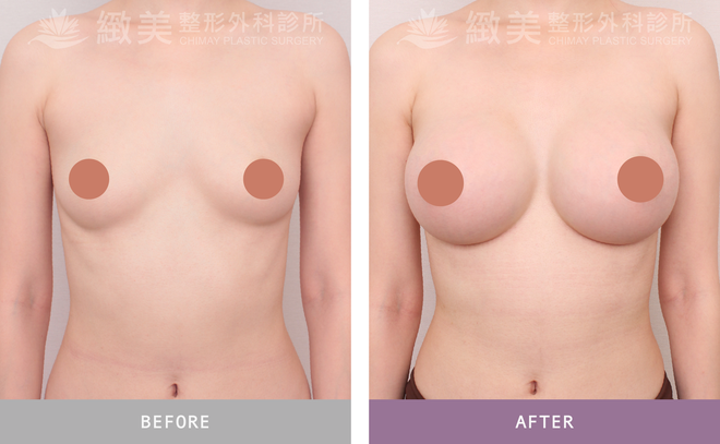 Xtra女王波隆乳 術後3個月