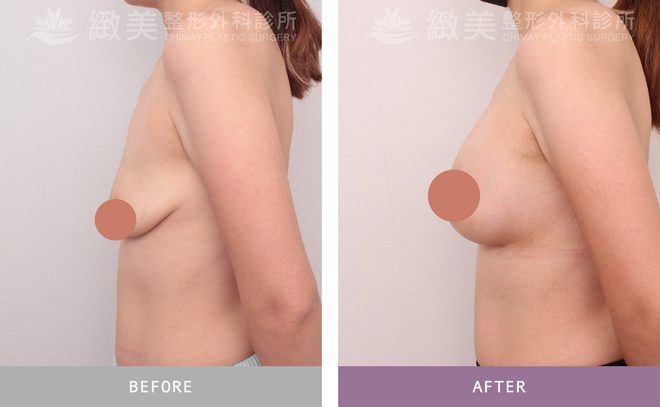 提乳+隆乳 術後3個月